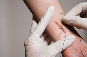 Suture Removal at Home