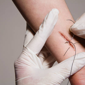 suture-removal-at-home-in-gurgaon