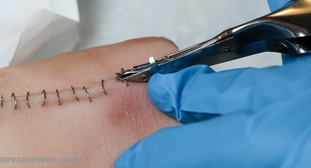 Suture Removal at Home 3 suture-removal-at-home-in-gurgaon